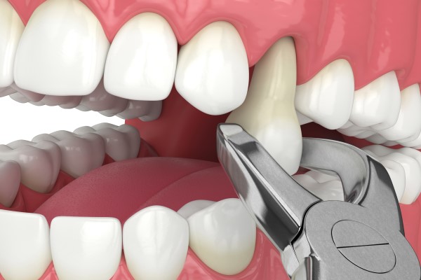 TOOTH EXTRACTION CLINIC